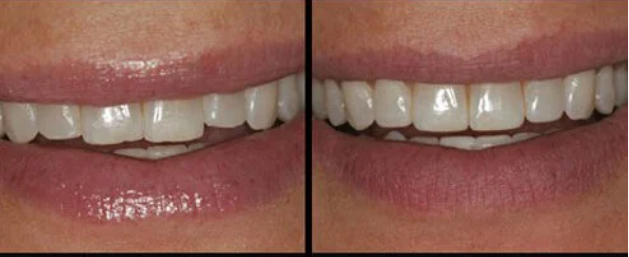 teeth with and without enamel shaping